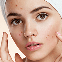 Acne with skincare